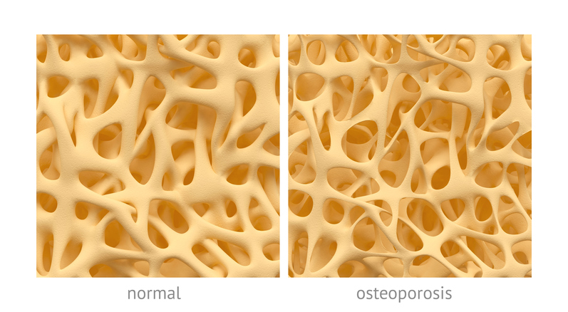 kost s normální stavbou a se stavbou při osteoporóze